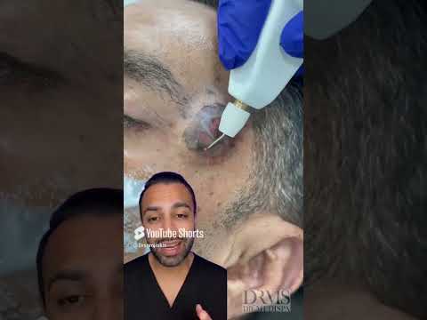 Shocking Seborrheic Keratosis Removal Transformation : - Dr.Somji