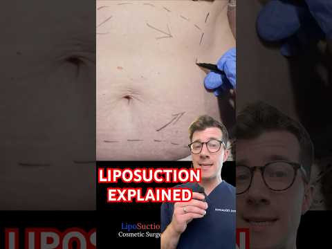 Doctor explains LIPOSUCTION for weight loss #shorts