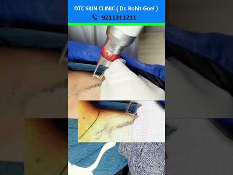 Permanent tattoo removal by laser | Dr. Rohit Goel | Laser treatment for permanent tattoo