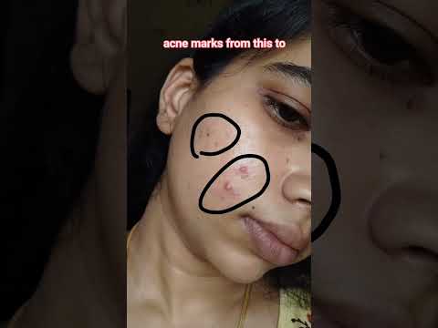 🔗 in description#tamilskincare #skincarebloggers#skincare#tamilskincareroutine#tamilskincareblogger