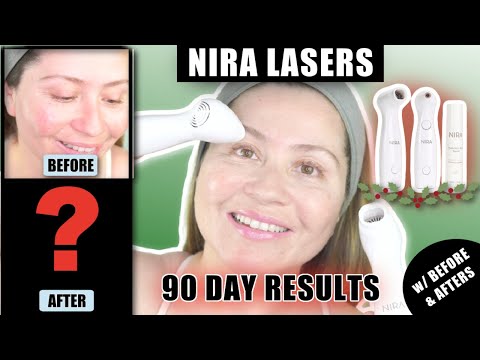 NIRA LASERS | 90 DAY BEFORE & AFTER RESULTS