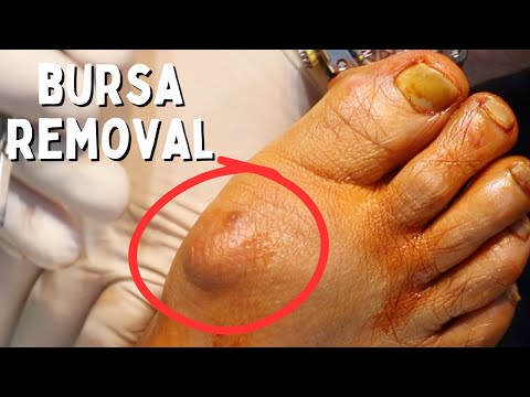 BURSA REMOVAL The Minimally Invasive Way!