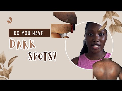 How to get rid of dark spots on your body.