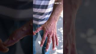 Pakistan Reports First Monkeypox Case in 2025, Patient Returned from Dubai | 4Sides TV English