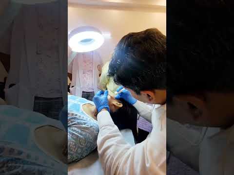 Mole Removal Delhi | Mole removal treatment