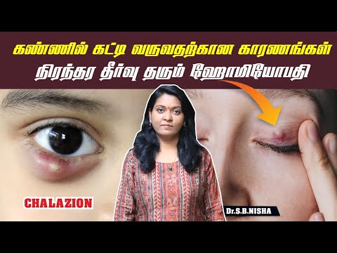 கண்ணில் கட்டி வருவதற்கான காரணங்கள் #Chalazion #Eyeproblem #swelling #homeopathy #pain #Dr.Nisha