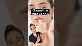 Dry, Cracked Lips That Don't Heal #dermatologist