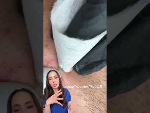 Satisfying Blackhead Extraction: Part II