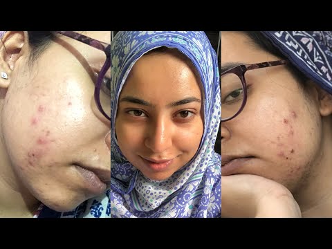 GET RID OF ACTIVE ACNE/PIMPLES WITH 4 PRODUCTS IN 7 DAYS | PROVEN RESULTS