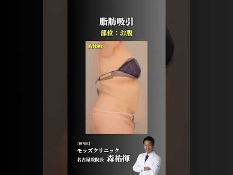 【脂肪吸引】100kgボディ→まるで別人ボディに #shorts