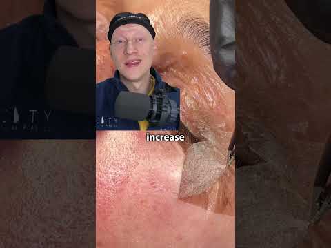 Chemical Peel Skin PEELING! | Plastic Surgeon Reacts