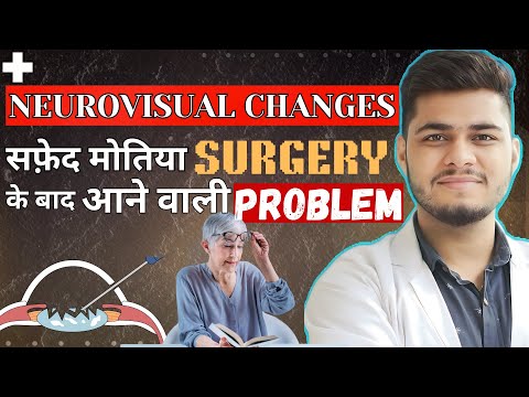 Neurovisual changes after cataract Surgery | Cataract surgery