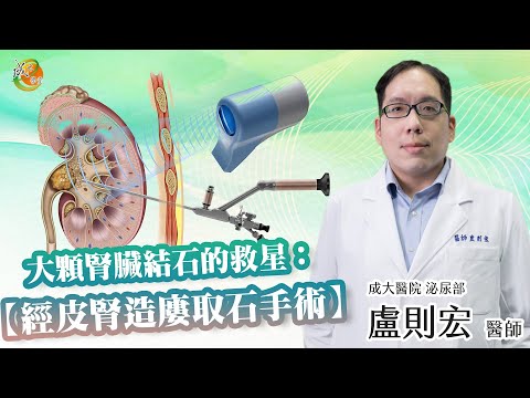 【經皮腎造廔取石手術】盧則宏醫師-成大e學堂