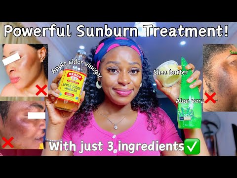 How to get rid of sunburn in 1 week! How to get rid of sunburn at home, sunburn treatment #sunburn