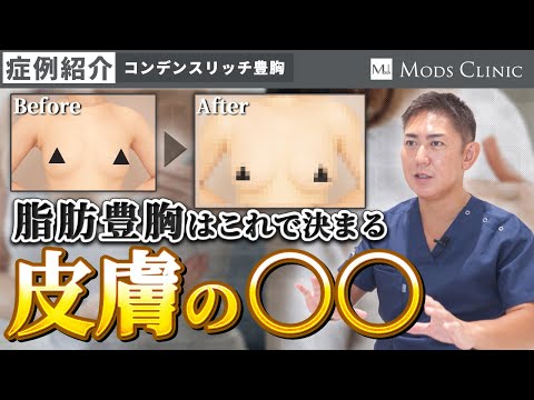 【症例紹介】実は脂肪豊胸で重要な要素「皮膚の〇〇」について/北條誠至 院長｜Mods Clinic モッズクリニック（脂肪吸引・注入）