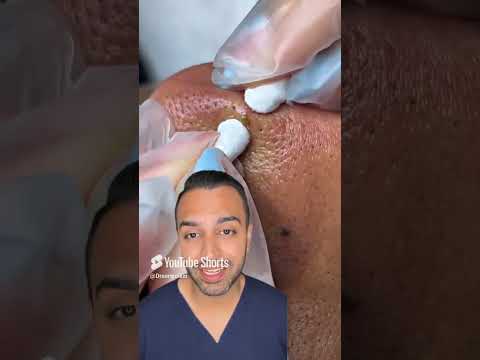 OMG I was not expecting that blackhead extraction on the nose! - Dr.Somji reacts