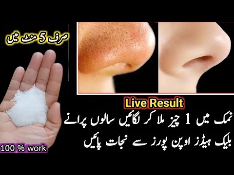 How To Remove Blackheads at Home | In Just 5 Minutes Best Way To Remove | Blackheads Removal Cream