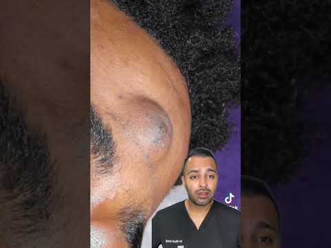 OH NO! Epidermal Cyst Explosion – You Have to See This! - Dr Somji Reacts