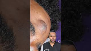 OH NO! Epidermal Cyst Explosion – You Have to See This! - Dr Somji Reacts