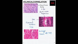 #Shorts|ClinicalCorrelation| NEET/NEXTPG/FMGE/MBBS| Viral Hepatitis | PAN | RHD