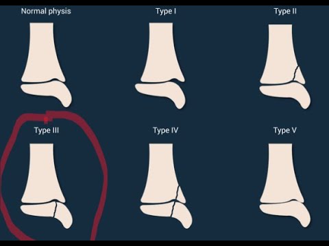 3rd Finger Metacarpal Head Salter Harris type 3 fracture