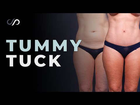 HOURGLASS Tummy Tuck & 360 Lipo Surgery RESULT!