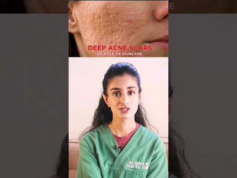 Deep acne scars treatment #acnescarsremoval #acnescars