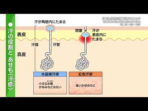 2021年8月21日放送　夏に注意すべき皮膚の病気②「あせも（汗疹）」　ひつじがおか皮フ科クリニック