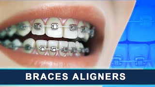 BRACES ALIGNERS | How Braces Work | Orthodontic Treatment