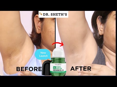 R.SHETH'S KESAR & KOJIC ACID UNDERARM ROLL ON  Review |  Control Odor & Sweat & Fade Pigmentation |