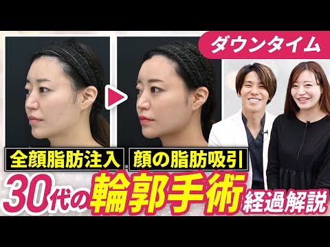 【二回目の脂肪吸引】顔の脂肪吸引＋全顔脂肪注入＋糸リフトの経過を解説！難易度が上がる脂肪吸引の再手術【術後3ヶ月レポ】