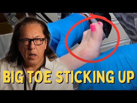 Correcting Patient's Big Toe Issue in Seconds!