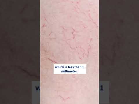 Can Varicose Veins Rupture?