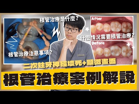 根管治療的步驟有哪些？根管治療還需要注意這些情況？就讓小許醫師利用這些根管治療的案例帶大家深入了解！｜【祐民牙醫－隱適美旗艦店】鑽石級楊大為醫師 #根管治療 #祐民牙醫 #蛀牙 #抽神經