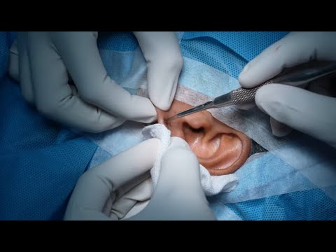 Ear Lobe Surgery for a Lady | Repair & Reconstruction Procedure