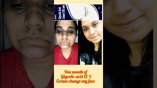 One Month Of Glycolic acid 12% cream change my face #drugstore #glycolicacid #shorts