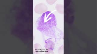 Spotting Smudge Cells | Neet PG & Next PG Pathology Guide