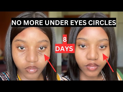 YOU ONLY NEED ONE PRODUCT. HOW I GOT RID OF MY UNDER EYE DARK CIRCLES