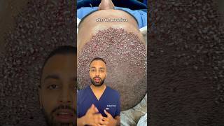 How Does Hair Transplant Work? Step by step explained by Dr Somji