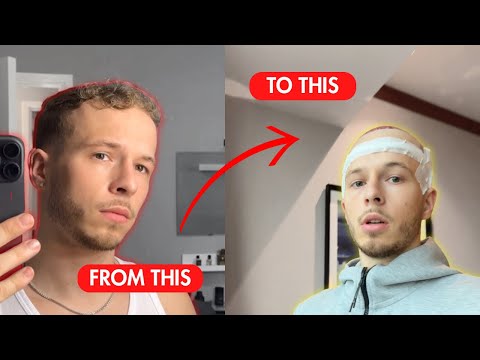 I went to Turkey for a Hair Transplant 👀