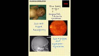 #Shorts|ClinicalCorrelation| NEET/NEXTPG/FMGE/MBBS| BlueMuffinRash|Saltand PepperRetinopathyAndSkull