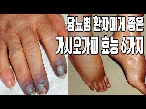 당뇨병이라면 알아두면 좋을 가시오가피 효능 6가지