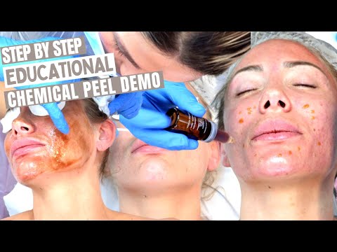 12 Step Chemical Skin Peel | Step By Step Procedure Performance Tutorial | Level 4 VTCT Accredited