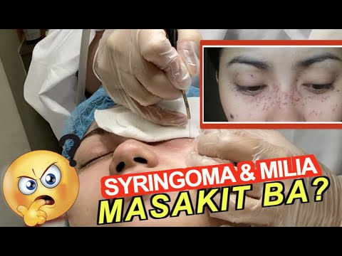 SYRINGOMA & MILIA REMOVAL (MASAKIT BA?) | Miss Menchie