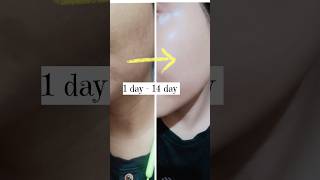 It works like a Magic 🪄 | 2% kojic Acid Serum best for pigmentation | 14 days challenge 💯 | #shorts