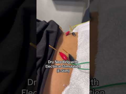 Dry Needling with E-Stim!