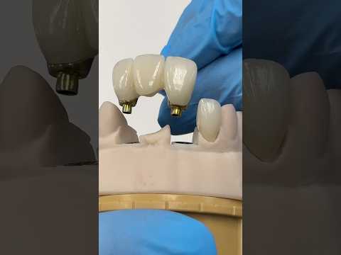 Pontic Bridge Implant with a Crown #lsk121shorts #dentist #teeth