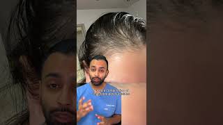 PRP & Polynucleotides for Hair Loss Before and After | Dr. Somji explains