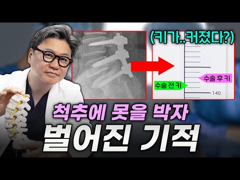 척추분리증 수술을 통해 환자분의 키를 되찾아 드렸습니다.｜참포도나무병원 이동엽 원장