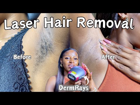 How to get rid of dark armpits using laser hair removal ft DermRays V6S| DermRays laser update